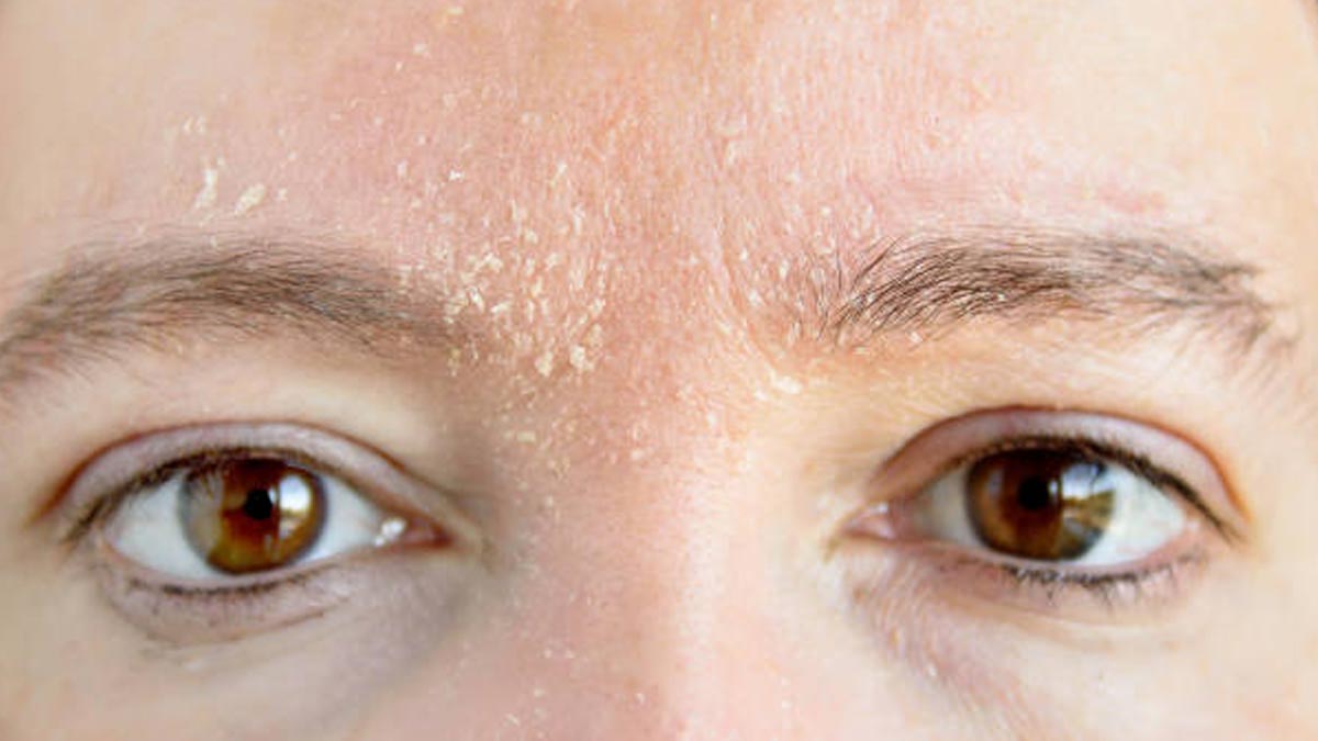 dry skin around forehead problems