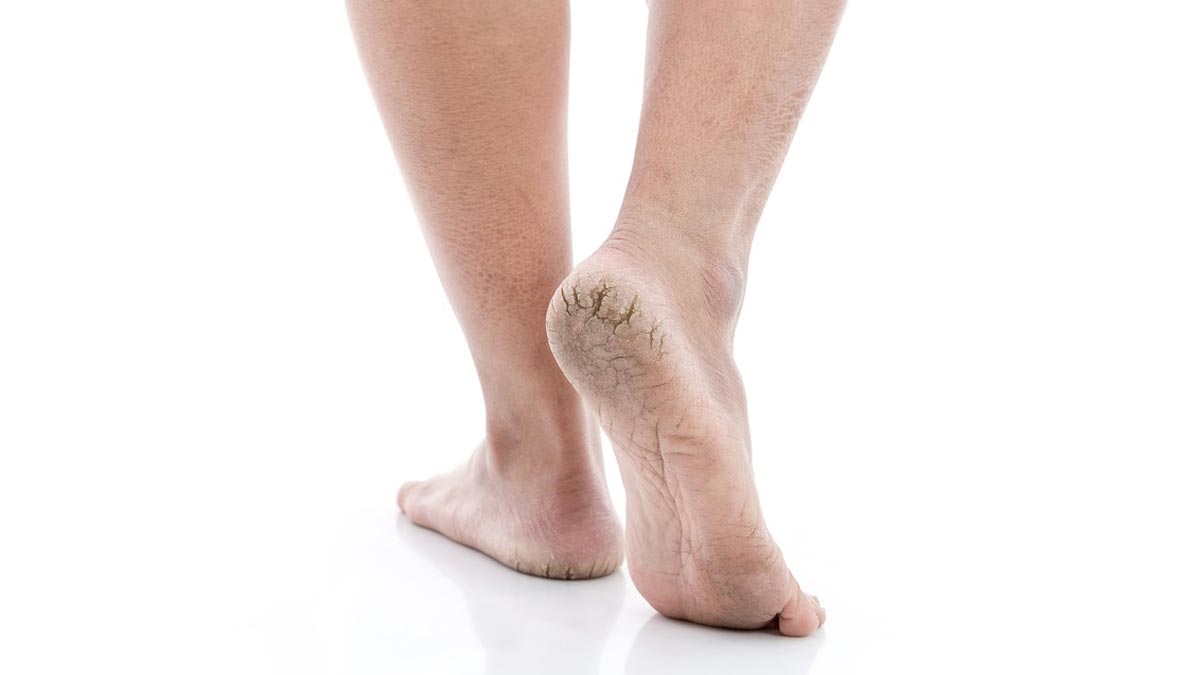 home remedies ghee wax for cracked heel