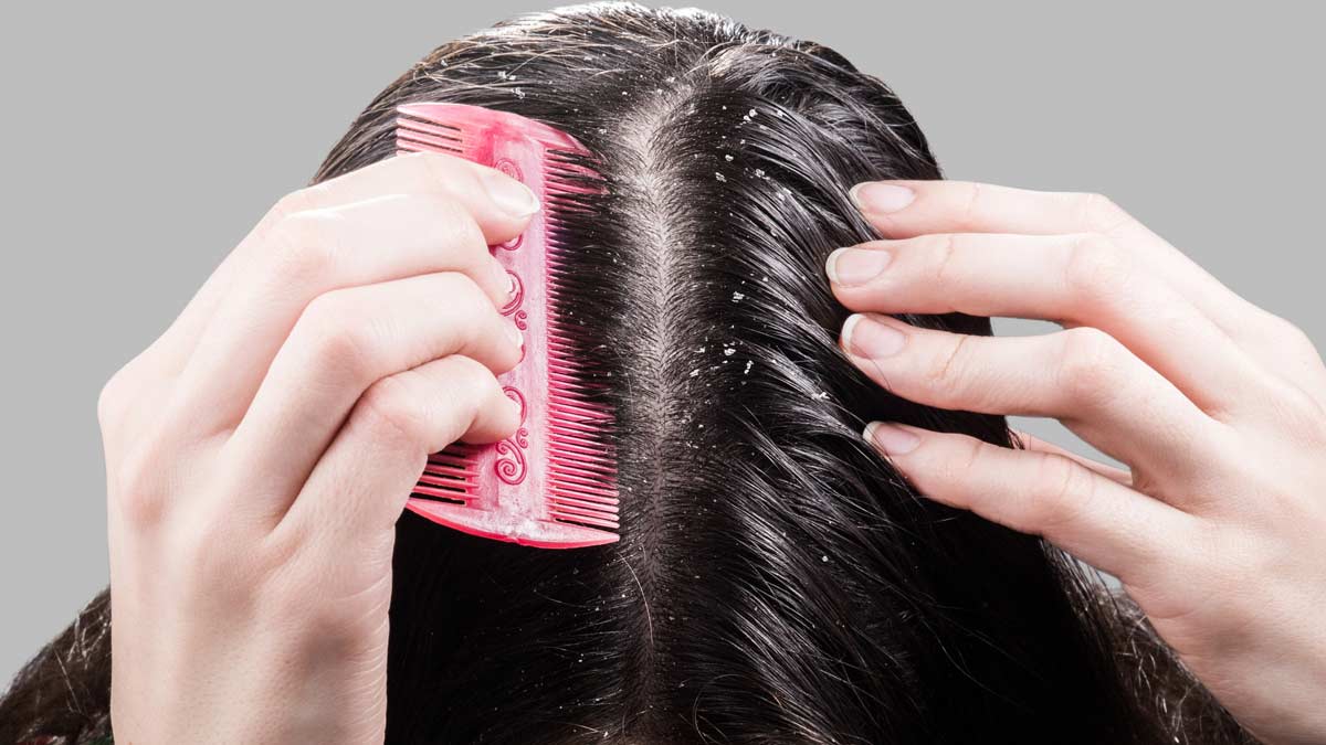 how to cure dandruff instantly