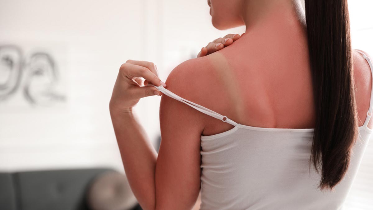 how to deal with sunburn in hindi
