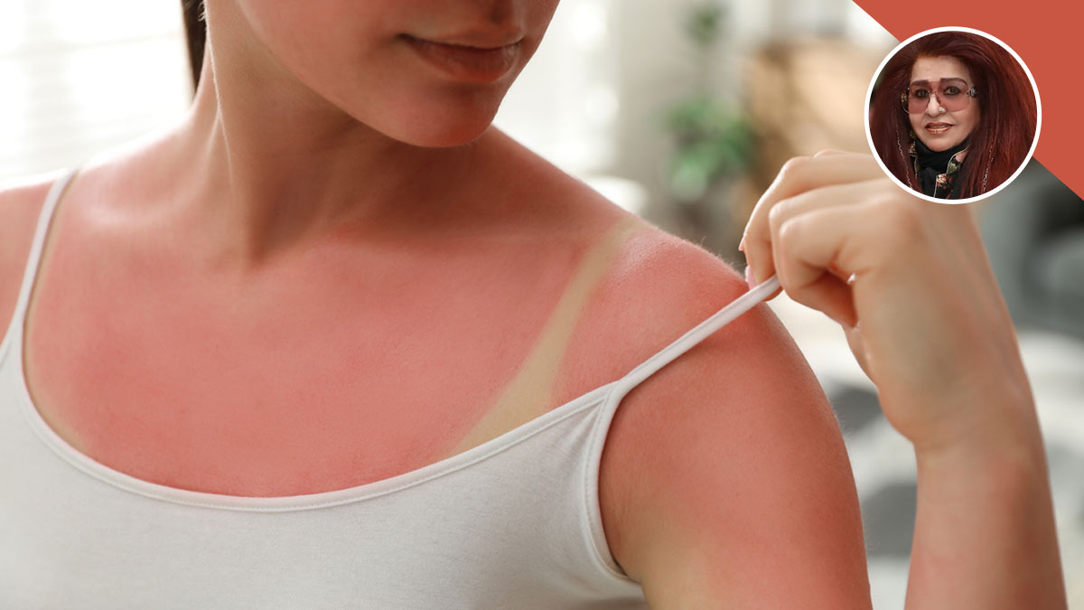 sunburn home remedies