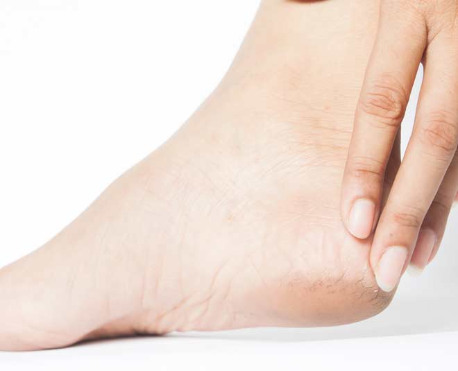 Cracked Heels | Dry Cracked Heels Treatment | Heavenly Foot Care