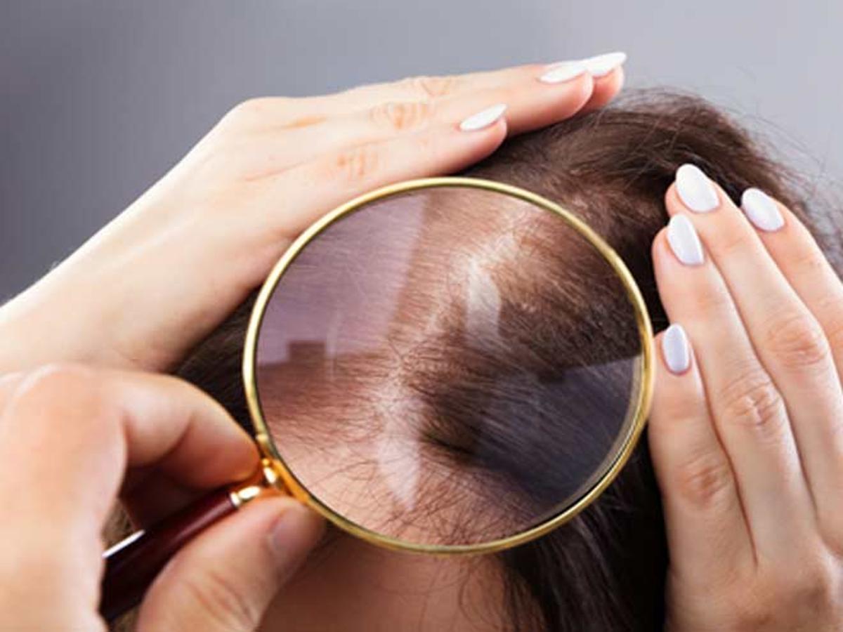 Hair Fall Gharelu Nuskha|कैसे रोकें बालों का झड़ना| Balon Ka Jhadna Rokne Ke Upay | gharelu nuskha for hair fall | HerZindagi Hair Fall Gharelu Nuskha|कैसे रोकें बालों का झड़ना| Balon Ka Jhadna Rokne Ke Upay | gharelu nuskha for hair fall | HerZindagi