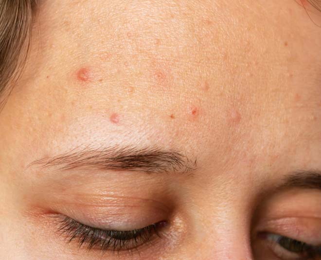 What Is Heat Pimple And How To Get Rid Of It In Hindi गर्मियों में हीट