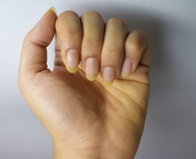 Yellow Nails? Here are the causes and how to treat them | The First Refresh  – thefirstrefresh