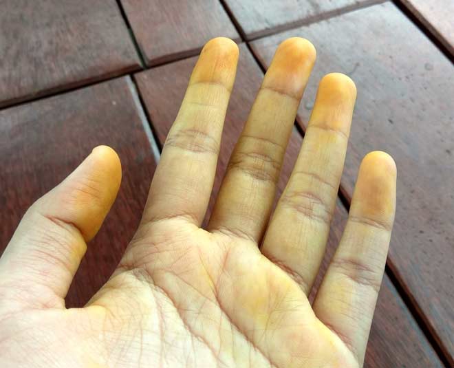 mild jaundice hands