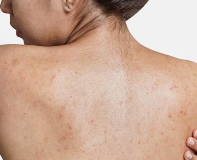 spot problemns and back pigmentaion