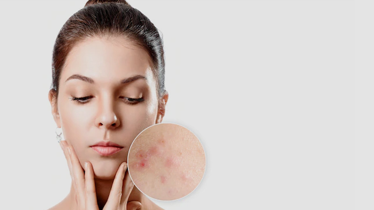 what-skin-care-products-cause-acne-remedies-for