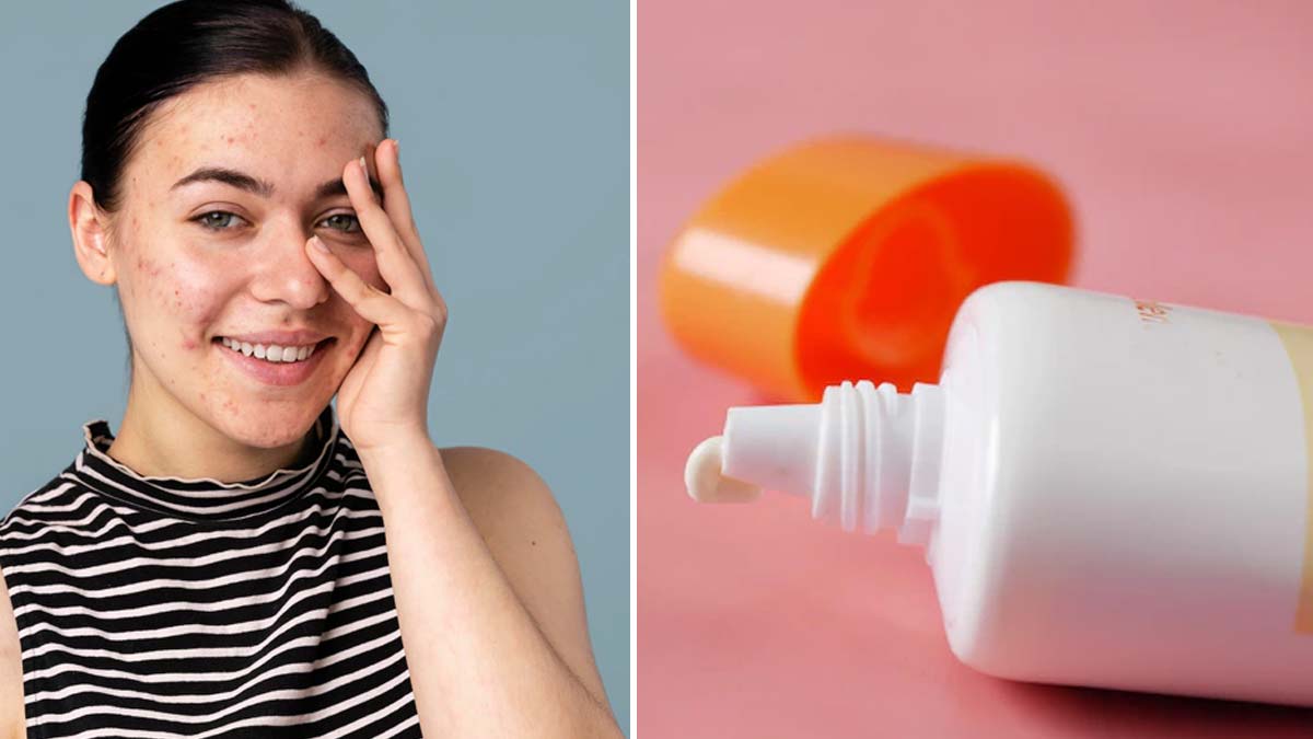 Can Sunscreen Cause Acne Breakouts In Summer ऑयली स्किन के लिए कौन सी