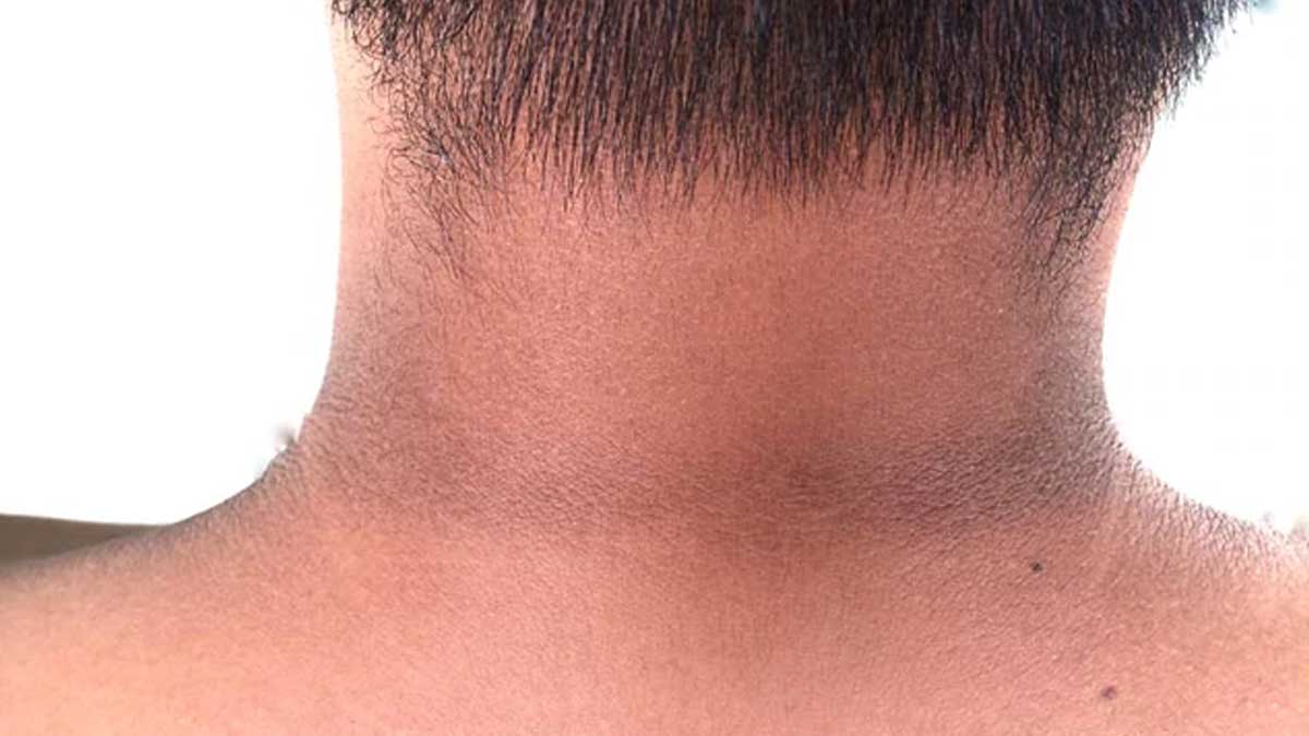 dark neck home remedies