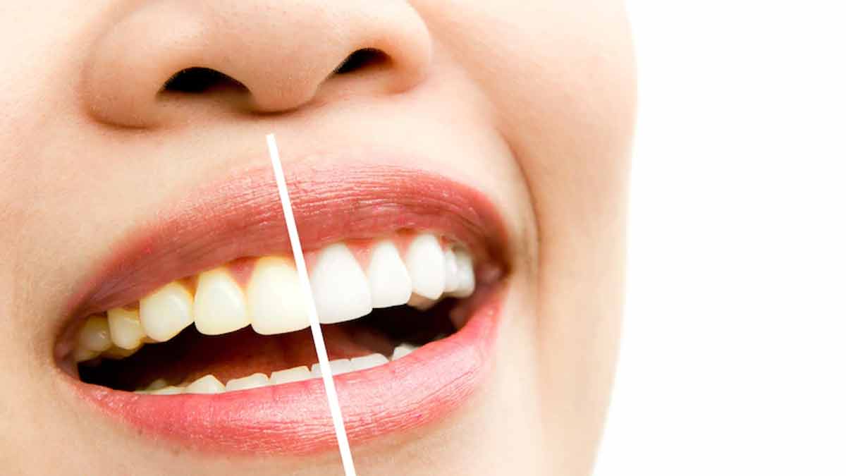 different foods that stain teeth