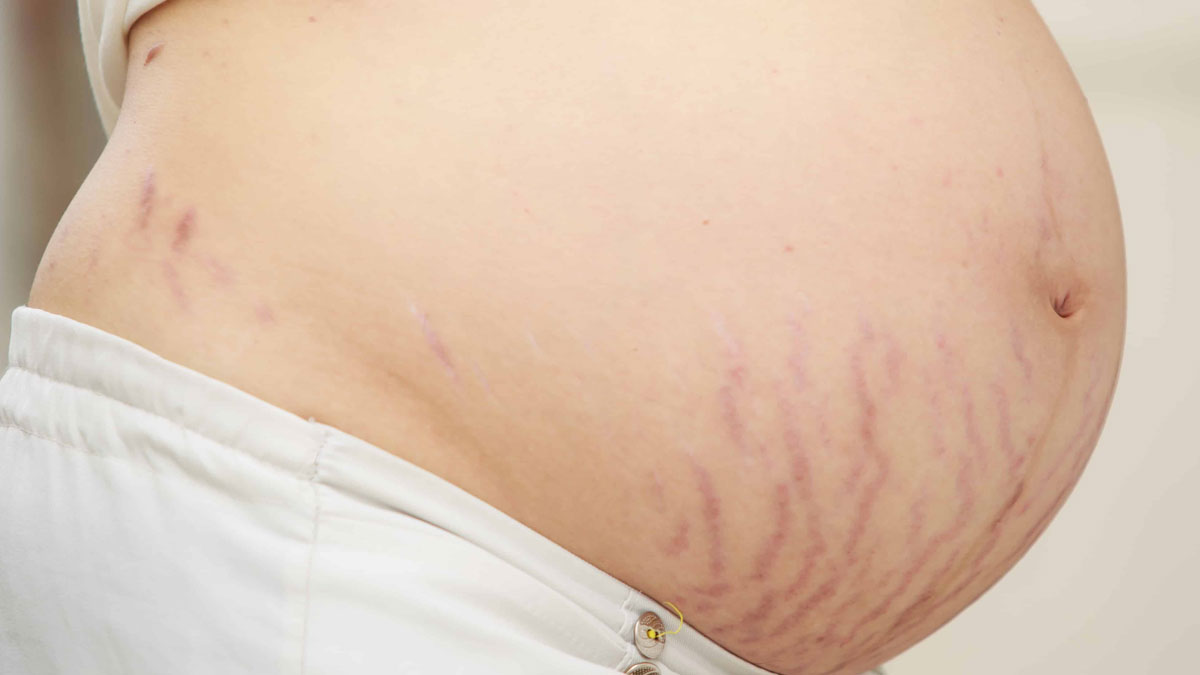 different ways to cure stretchmarks due to pregnancy