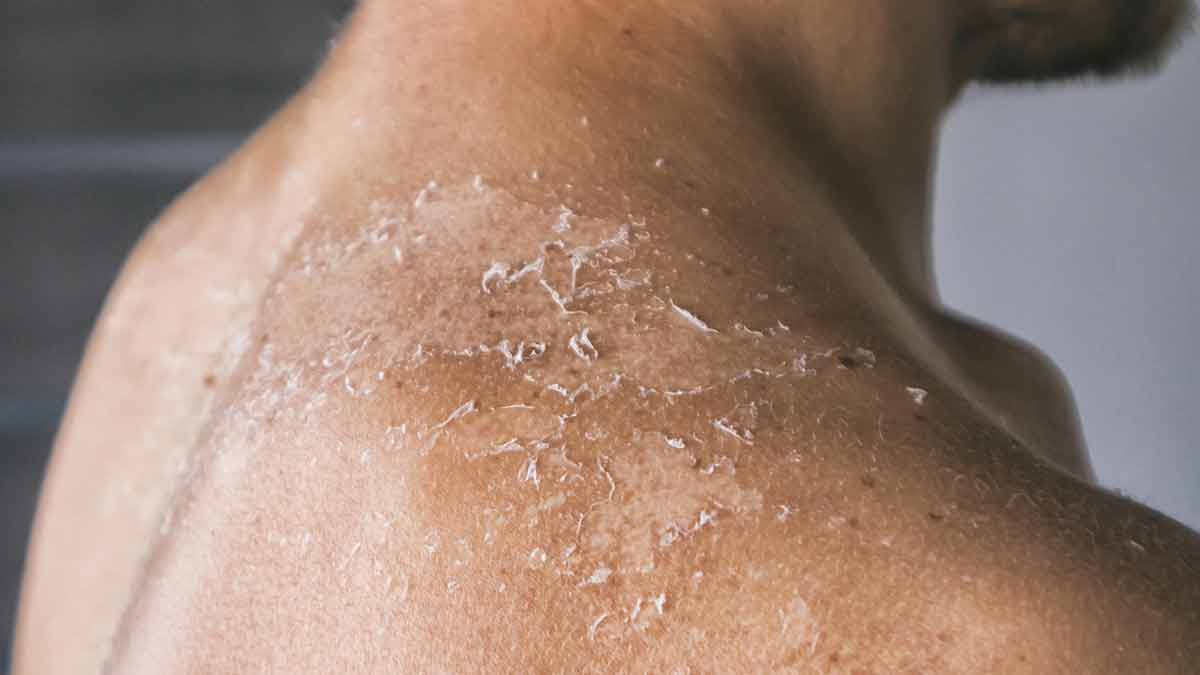 dry skin and its related issues with coconut oil