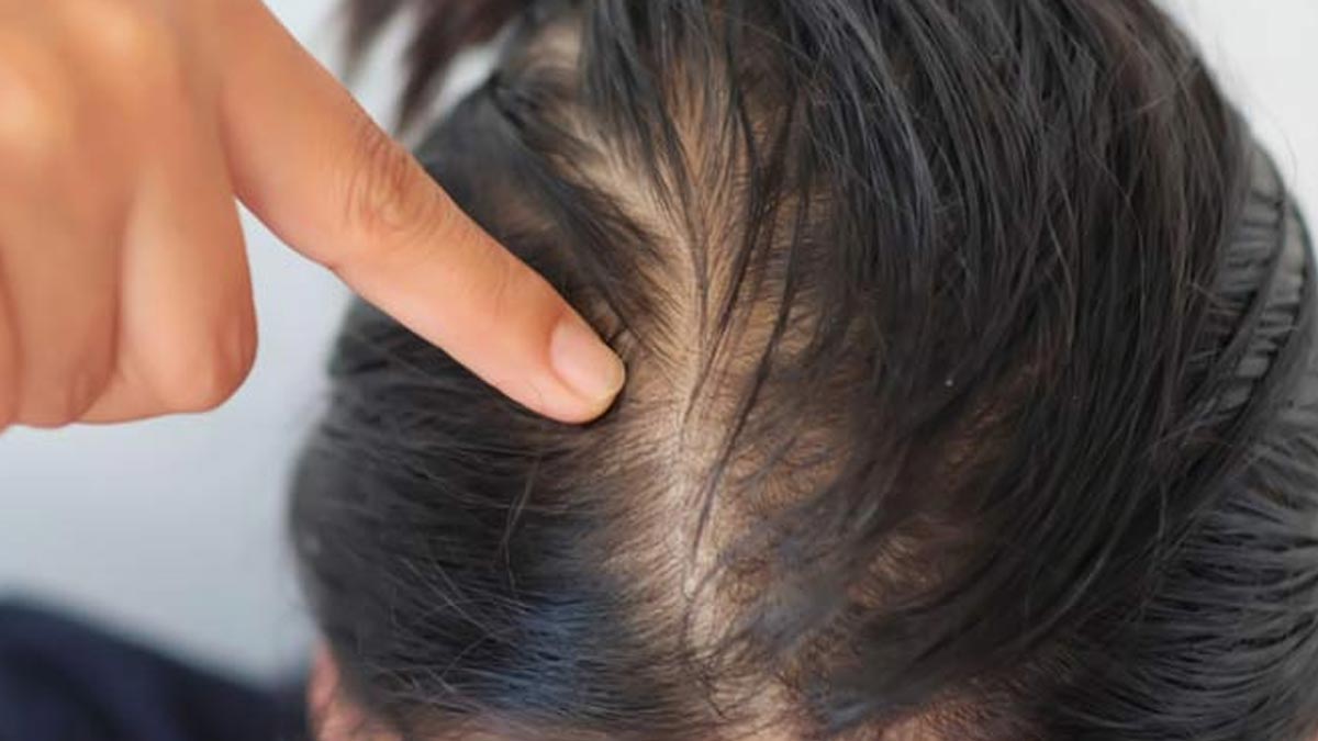 female hair thinning causes
