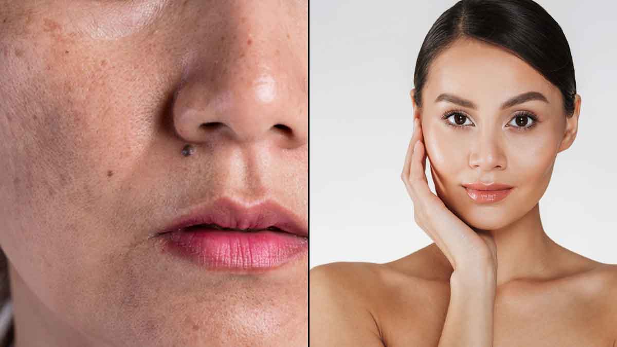 home remedies for skin pigmentation