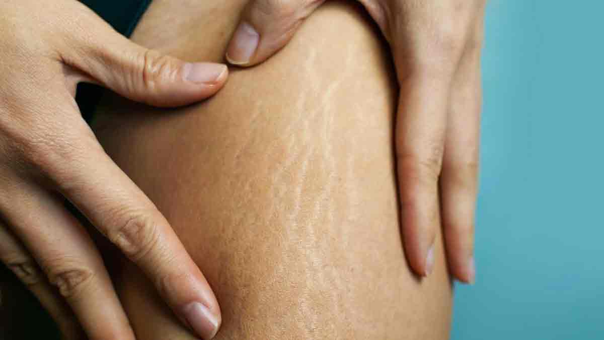 how stretch marks can be reduced