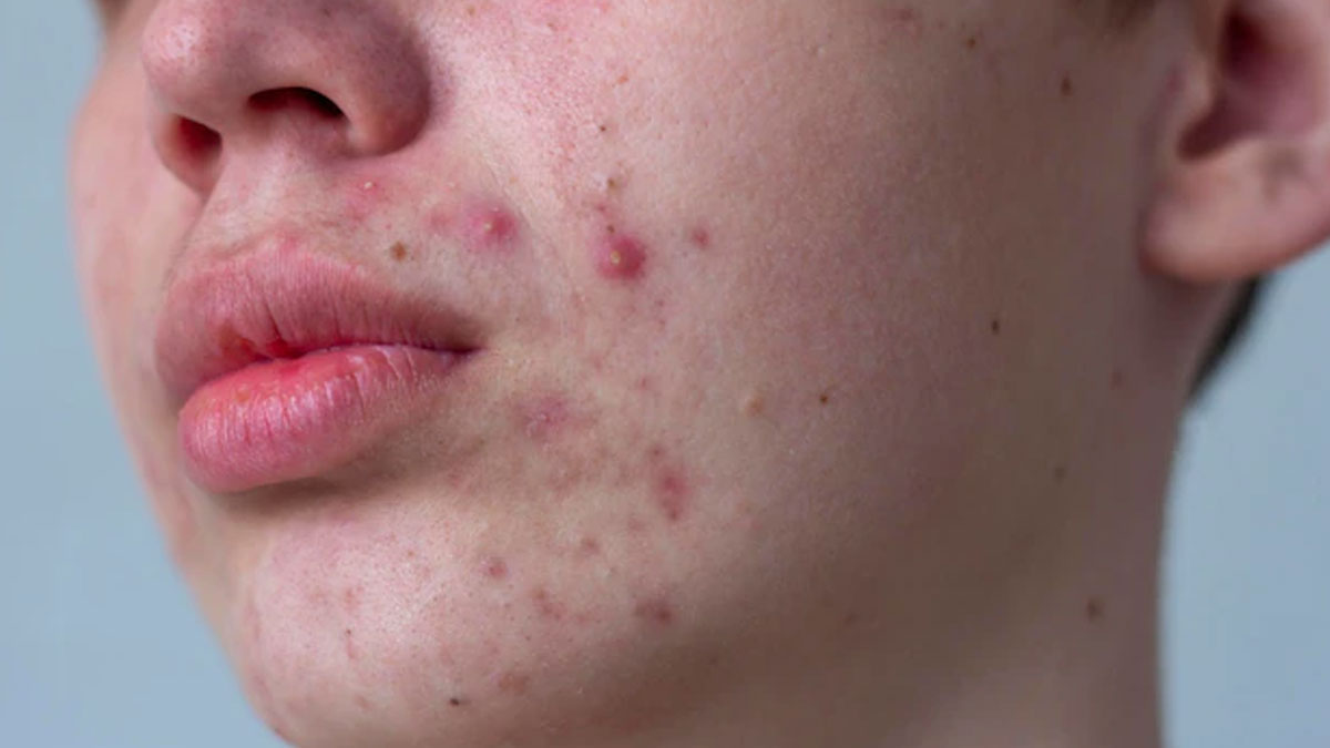 which products can cause acne