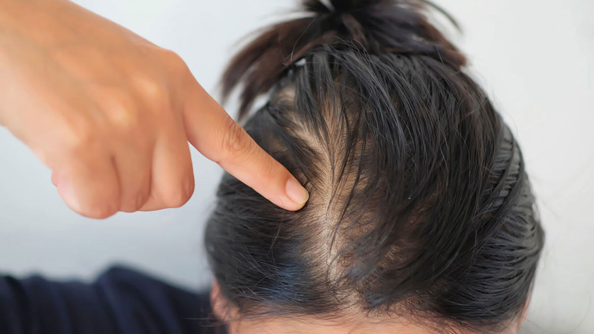 How to Control Hair Fall After Delivery? Postpartum Hair Loss Remedies |  MyloFamily