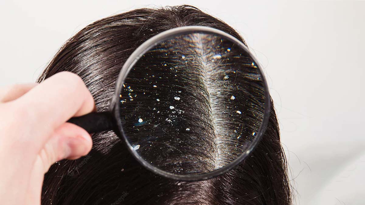 Home Remedies For Dandruff