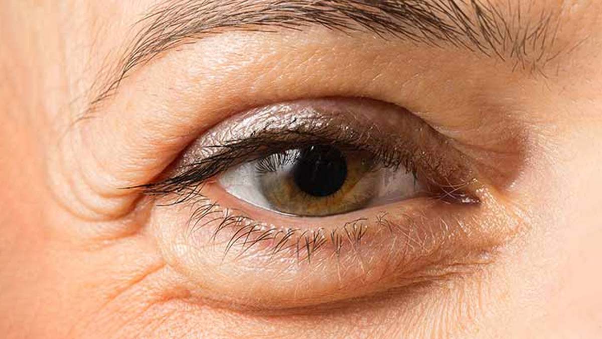 Bags Under Eyes Causes आंखों की सूजन कम कैसे करें Under Eye Kya Hota