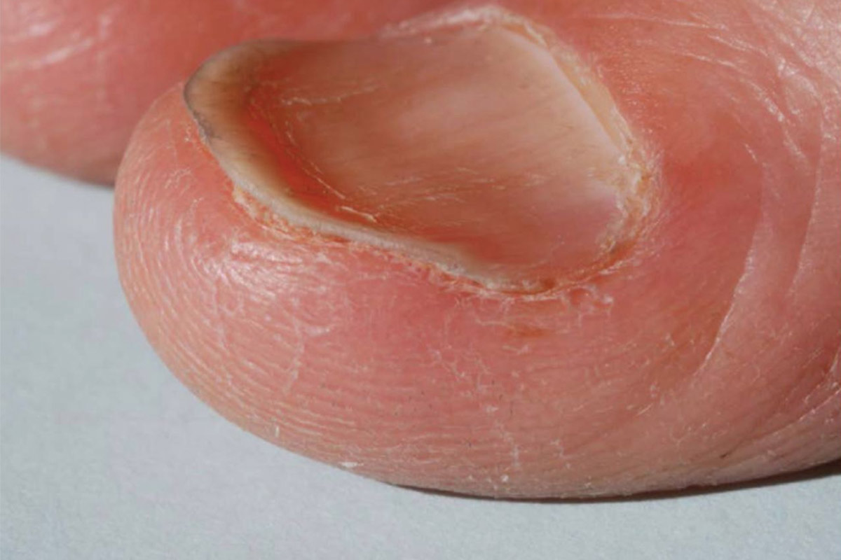 Spoon Shaped Nails नाखून के रोग का इलाज Nails ka Kharab Hona what do spoon shaped nails