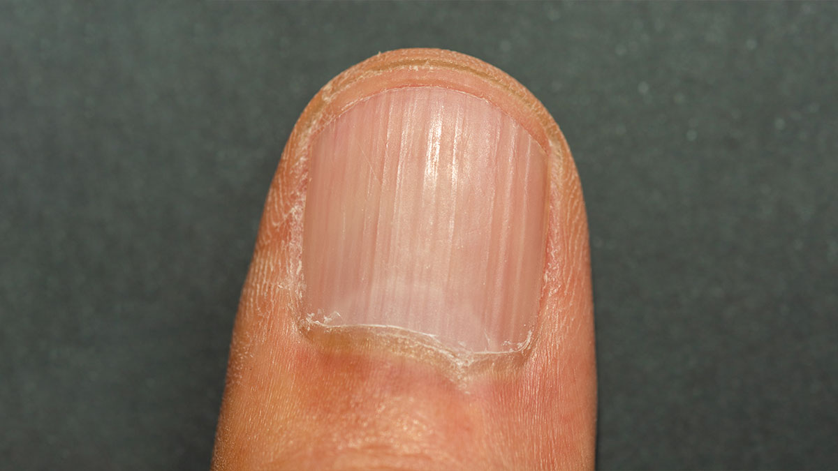 Ridges In Nails - Causes Of Nail Ridges And How To Treat Them - YouTube