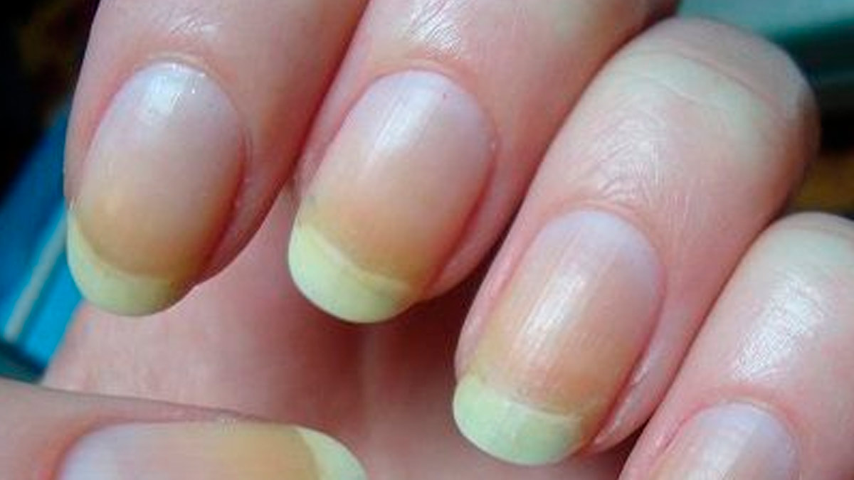 yellow nails to reduce