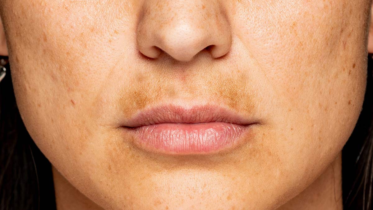 How to control pigmentation around the lips
