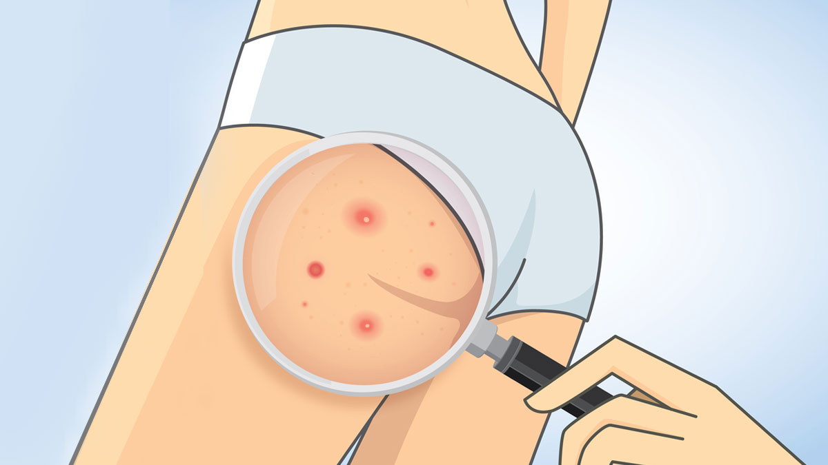 Your Thong Is Giving You Butt Acne, and Other Skin and Pimple Tips