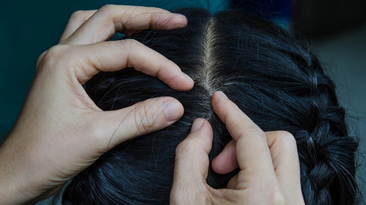 9 Best Hair Baldness Treatment at Home in Hindi  बल क गजपन क घर पर  इलज कस कर