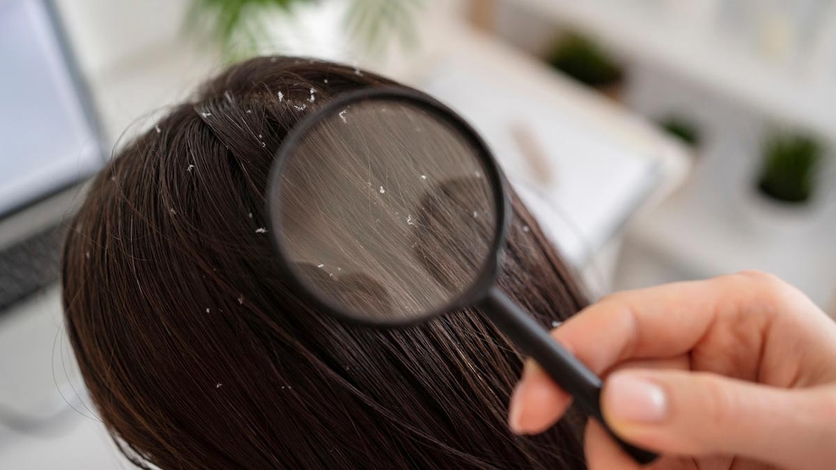 Hair mask for anti dandruff in hindi