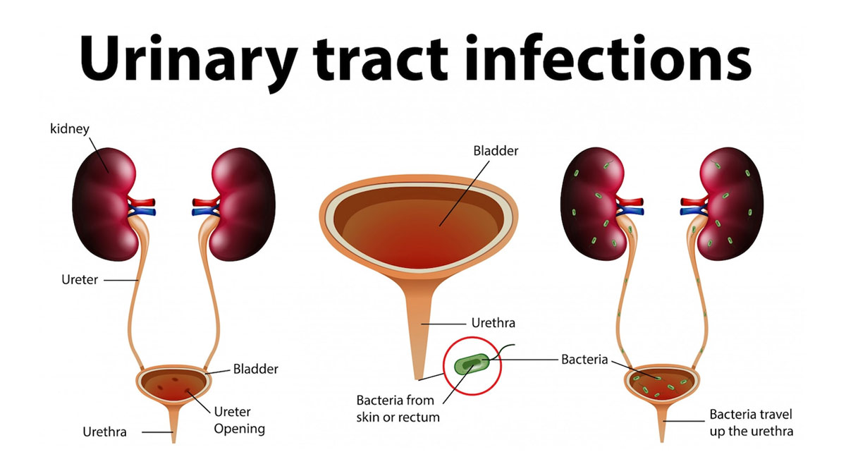 uti-treatment-at-home-uti-ke