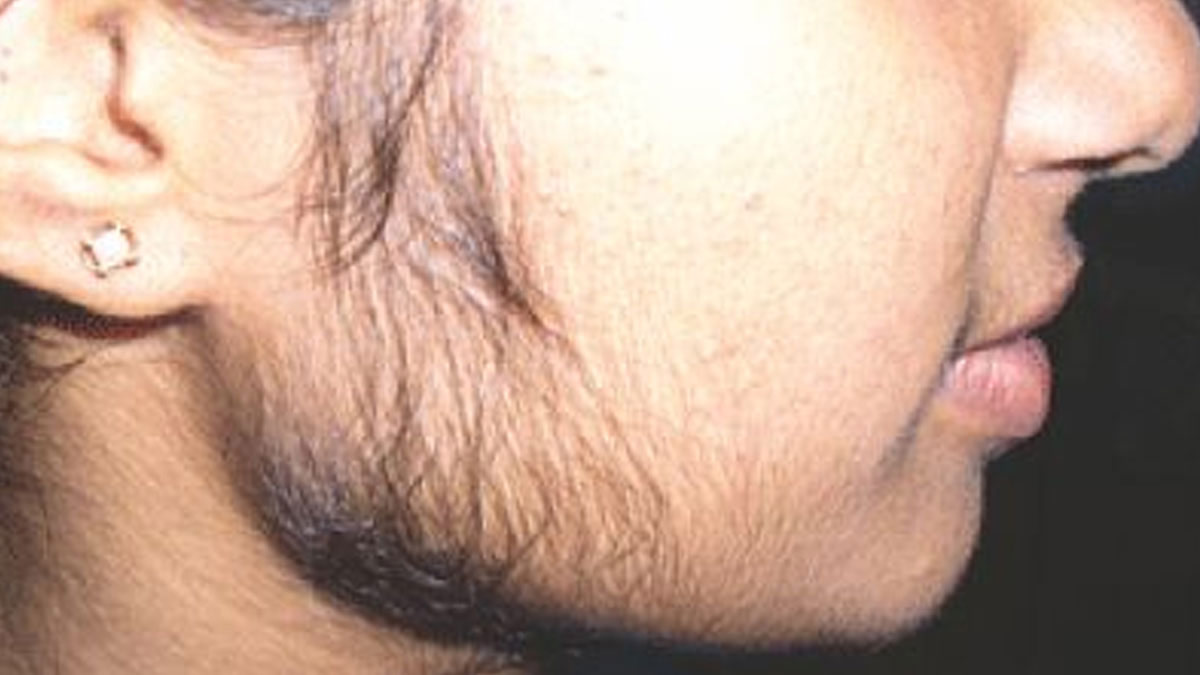 Reasons For Facial Hair by expert