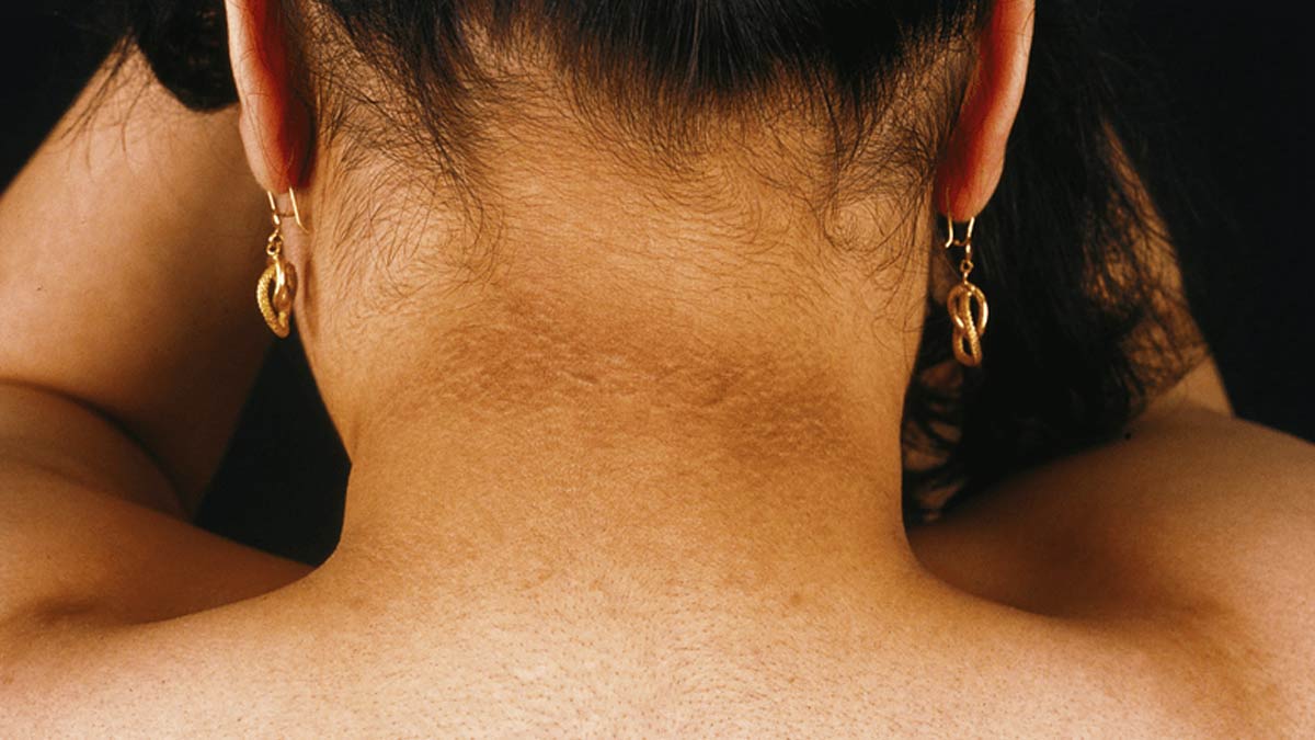 black neck treatment picture