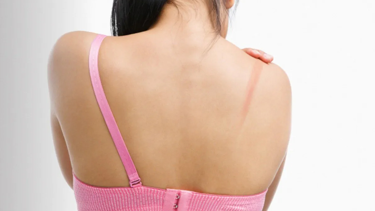How to Get Rid of Bra Strap Marks Naturally