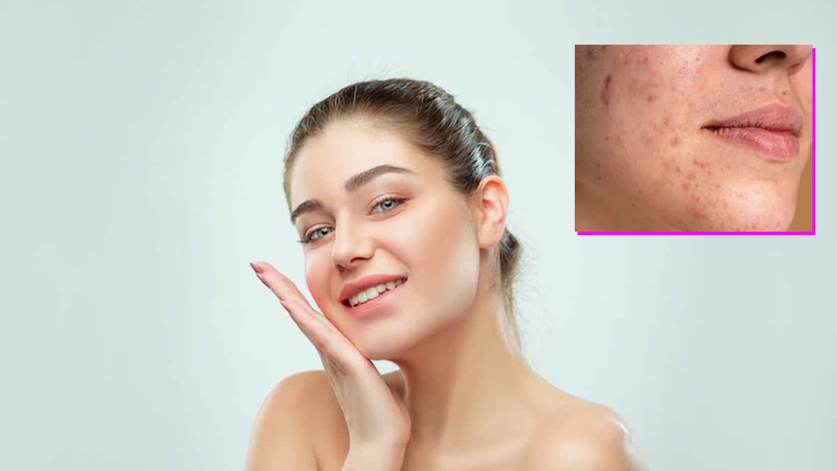 How To Reduce Pimple Marksदागधब्बे कम करने के उपाय Daag Dhabbe Kam