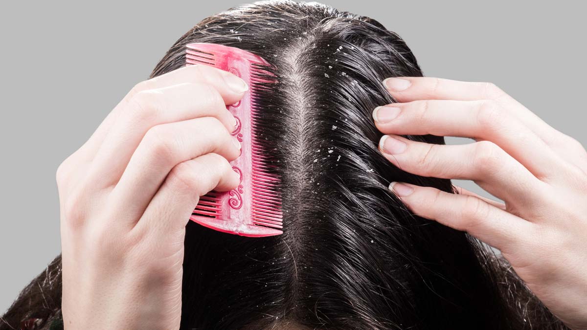 Hair Dandruff| डैंड्रफ के उपाय जानें| Ghee Ke Upay | ghee for dandruff | HerZindagi