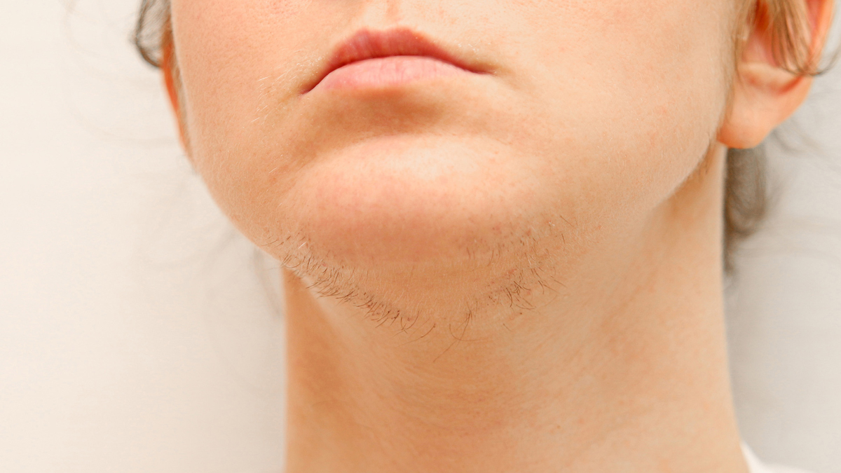 Facial Hair PCOS Hair On Face HerZindagi