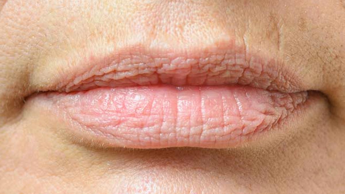 how-to-get-rid-of-wrinkles-around-your-mouth-and-lips-naturally