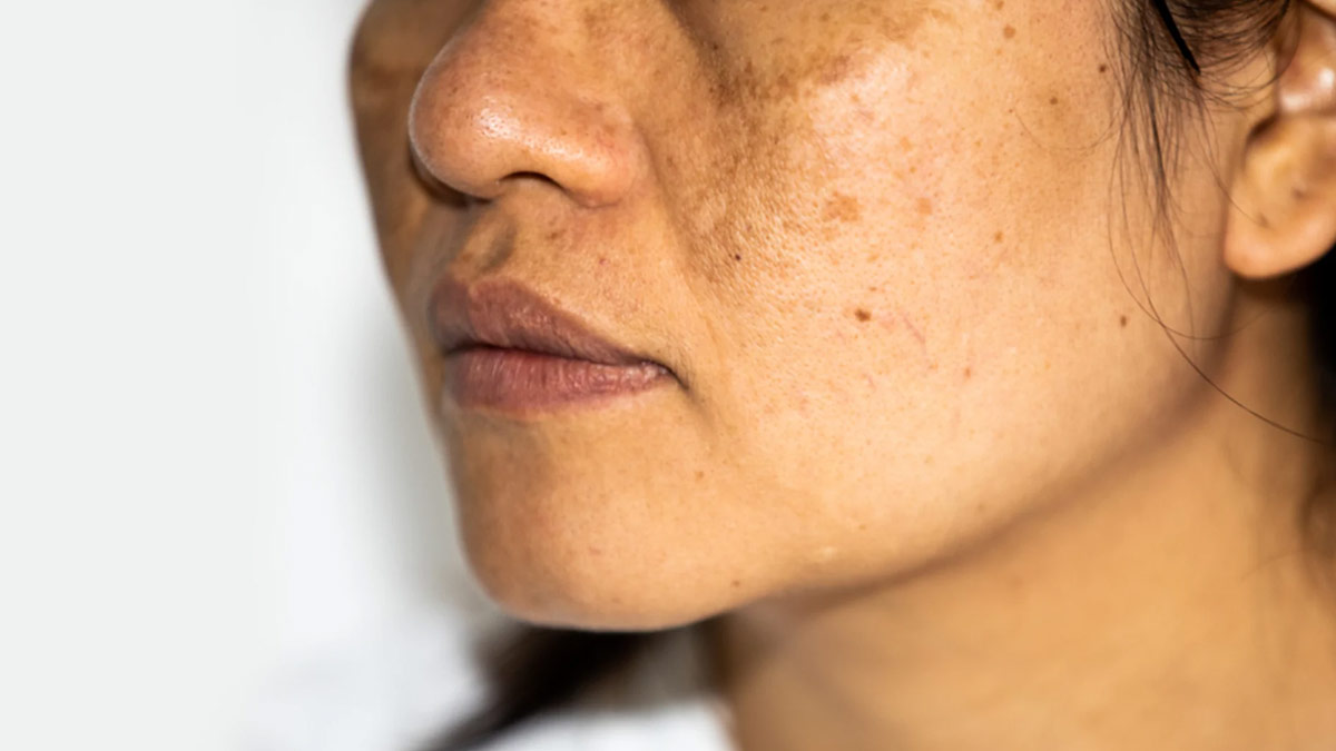 Hyperpigmentation Treatment Aloe Vera Gel से कैसे दूर होंगी झाइयां