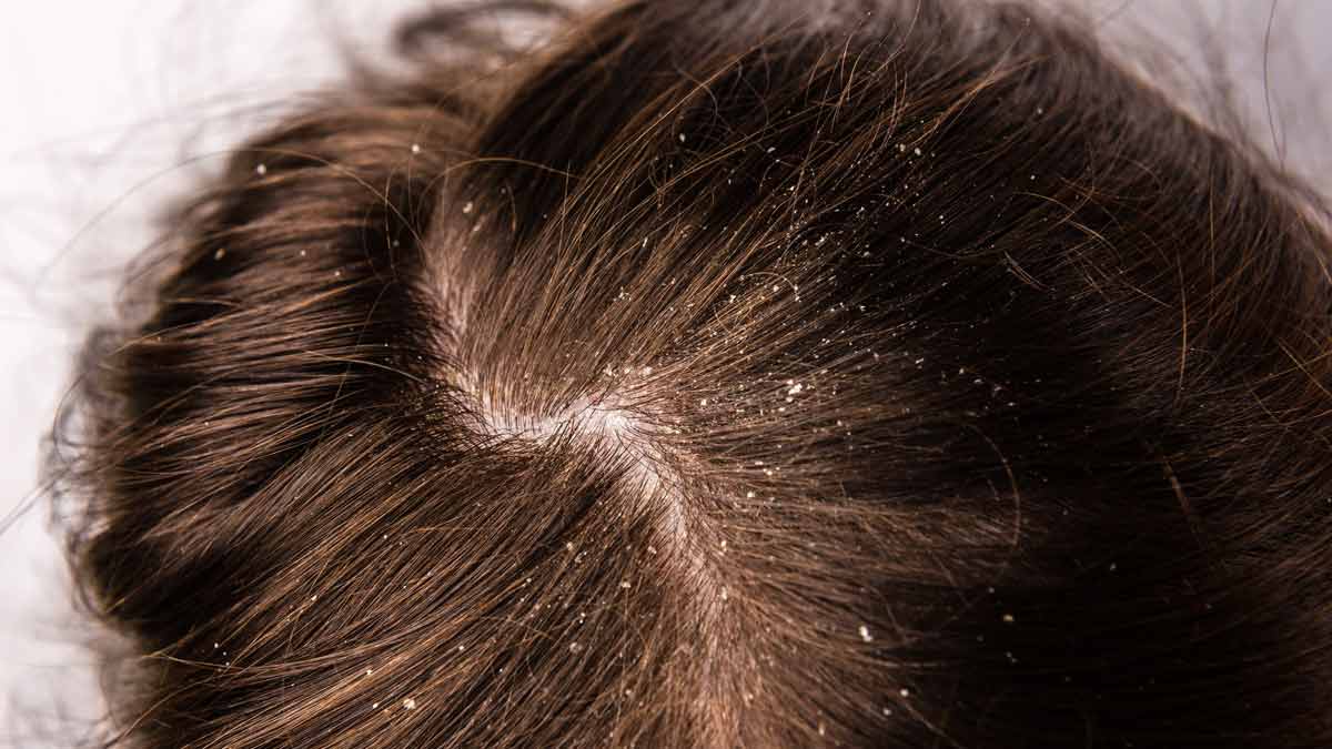 reasons of dandruff