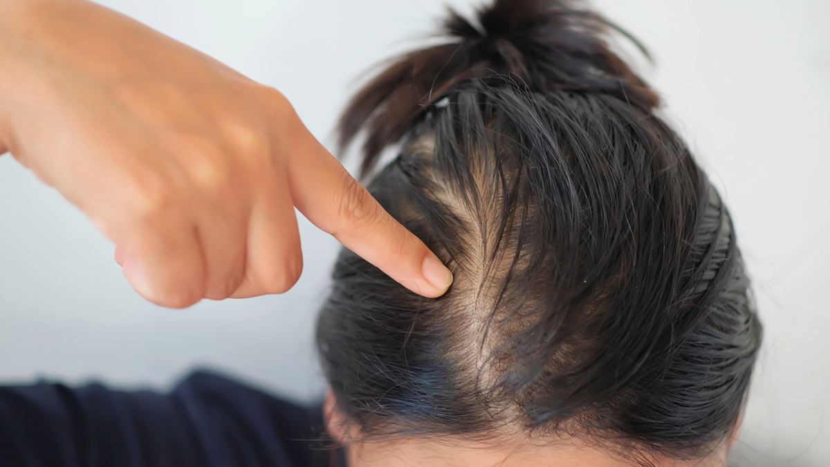 remedies for hair fall at home