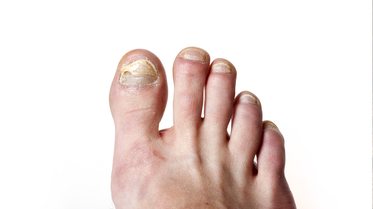 toe nail fungus easy remedies