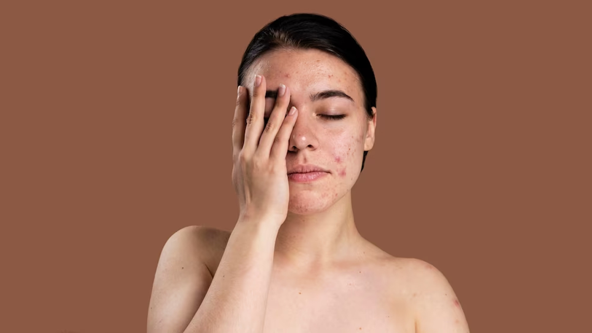 can coconut oil cure acne