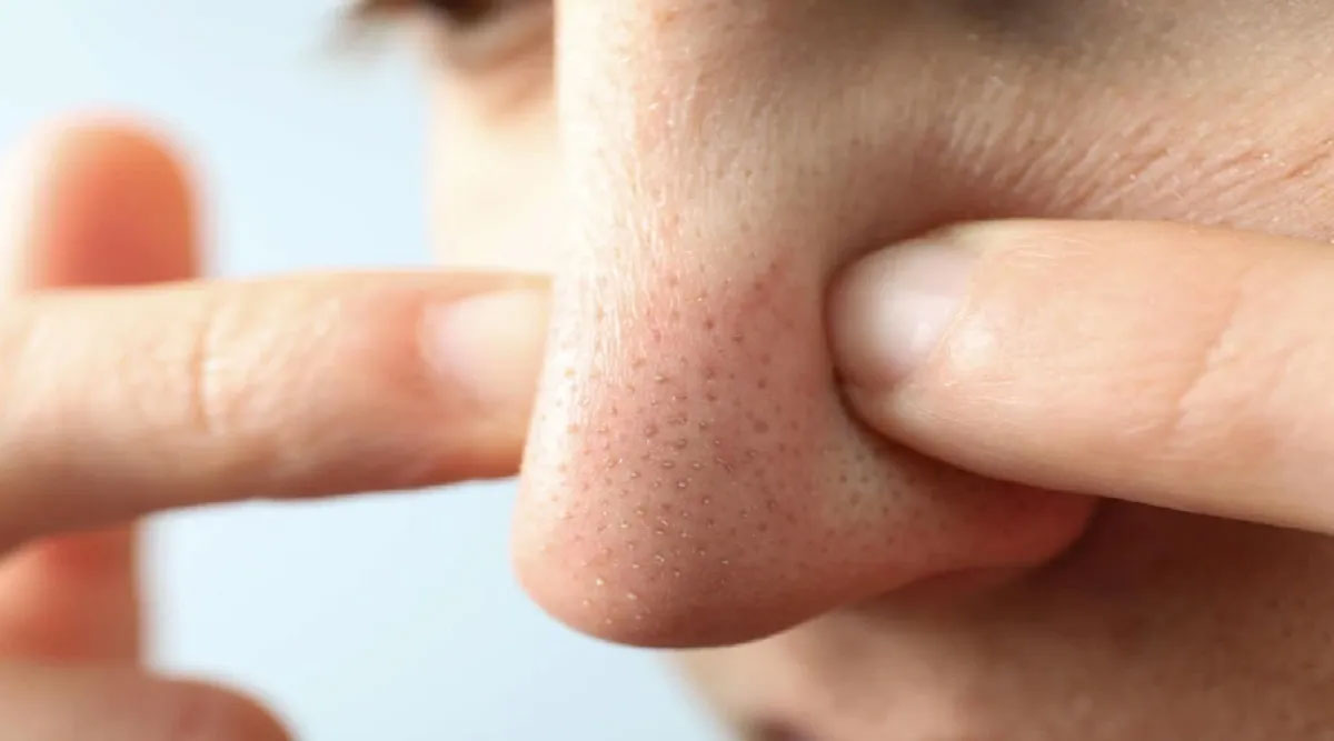 blackheads and its issues