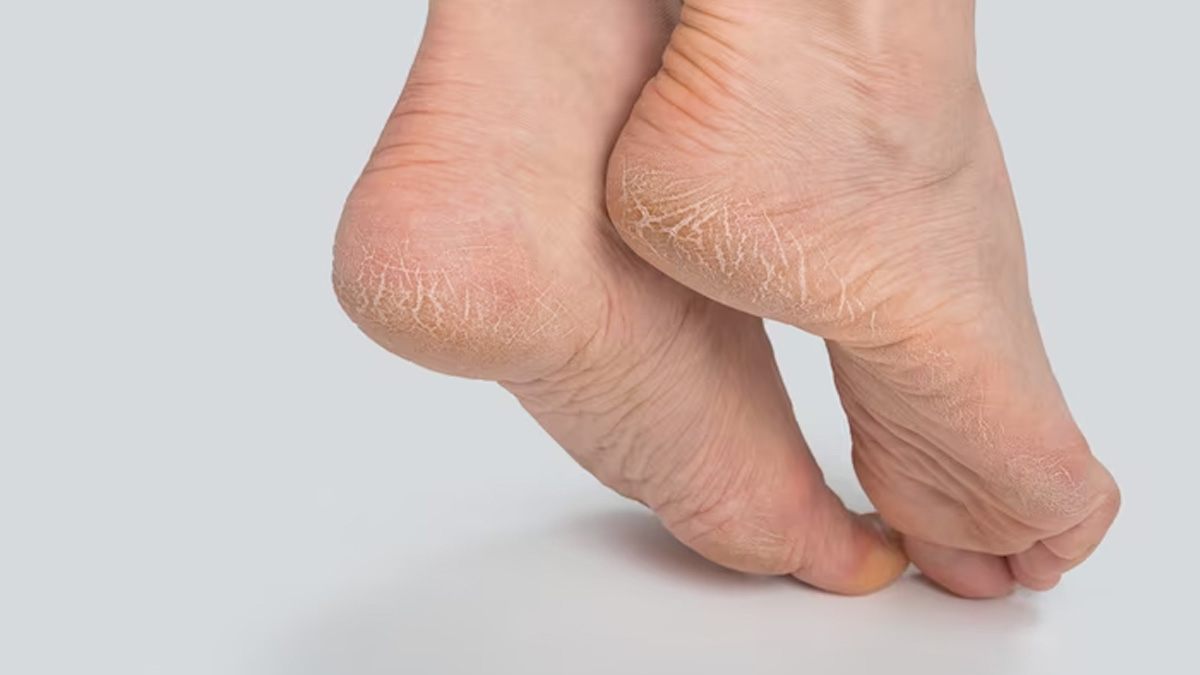 Amazon.com : Vingtank Winter Anti Cracking Frost Foot Repair Cream,Cracked Heel  Repair For Dry Skin or Rough Heels（2Pcs x 15g） : Beauty & Personal Care