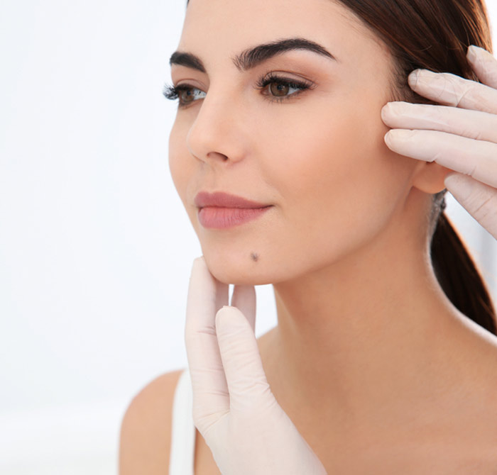 mole on chin lucky signs