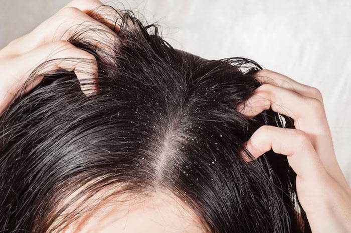 Dandruff home remedies