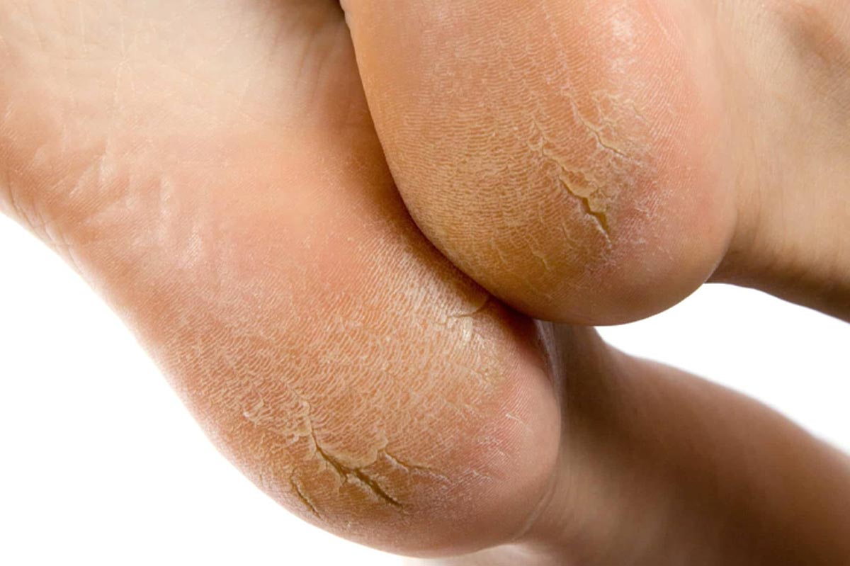 cracked heels problems fro women