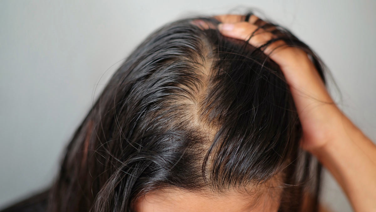 पीसीओडी के कारण झड़ते हैं बाल? घर पर बनाएं तेल | diy hair oil to control  pcod hair fall | HerZindagi